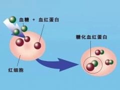 HbA1c-糖化血红蛋白可以提高糖尿病诊断效率