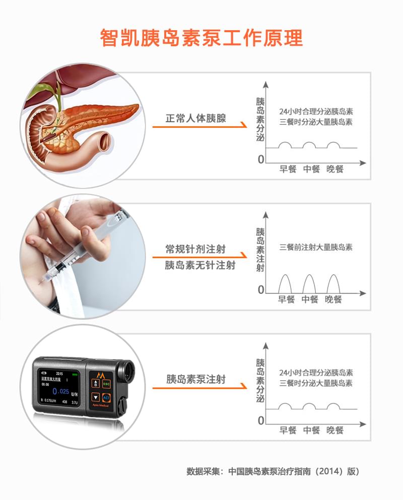 胰岛素泵的工作原理和理论依据