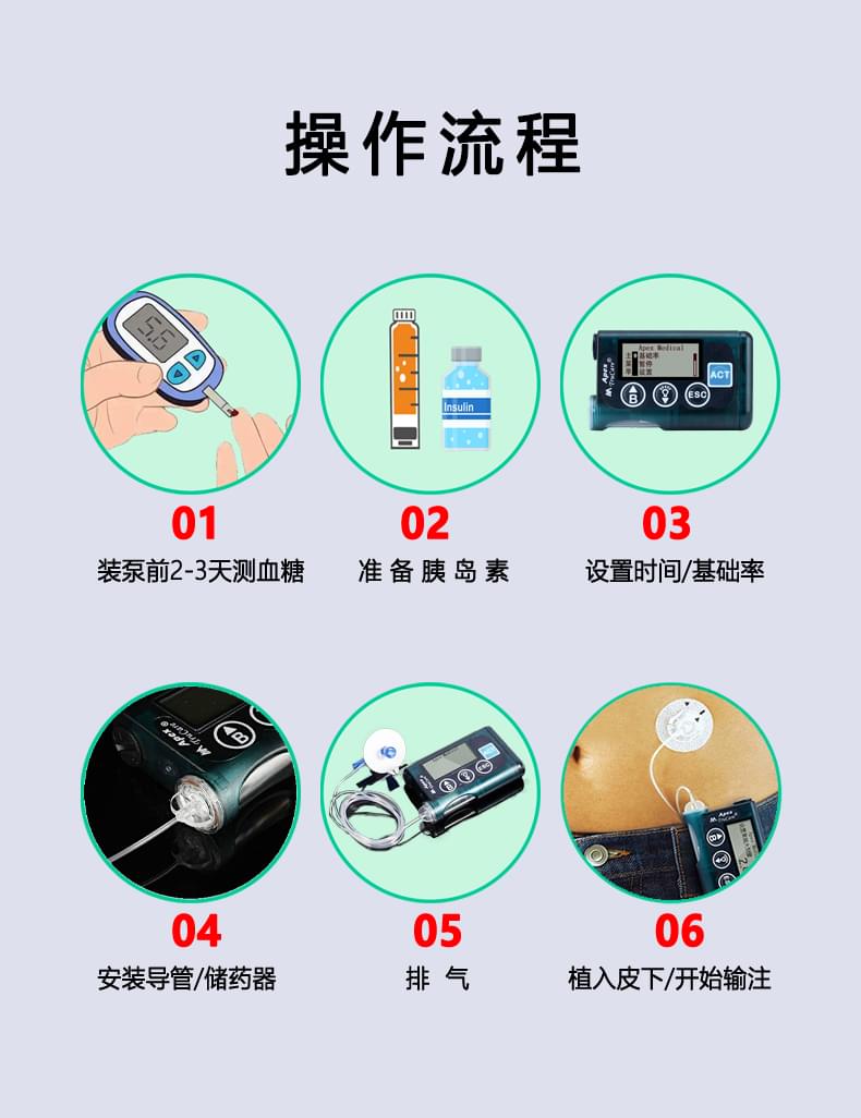 智凯<a href='http://www.zksip.com/ktzs/ydsbbd/96.html' target='_blank'><u>胰岛素泵安装</u></a>流程