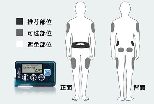 胰岛素泵在使用过程中的常见问题